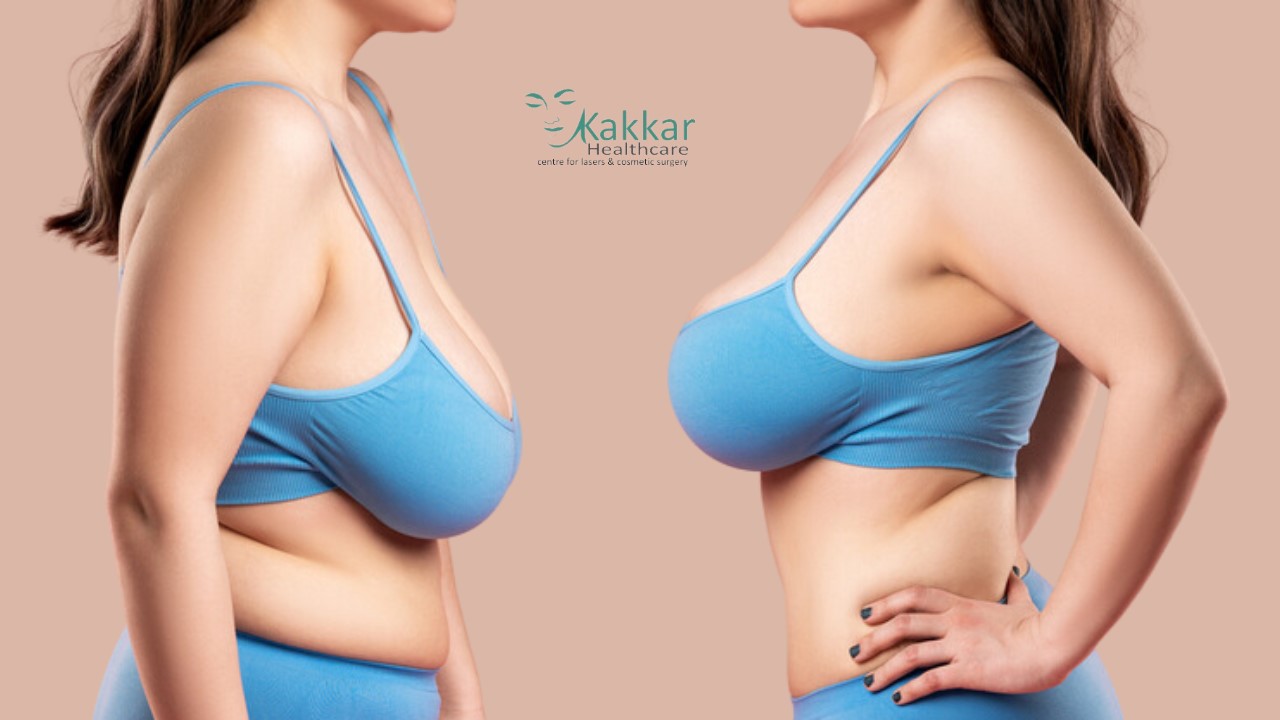 The Marvels of a Mommy Makeover by Kakar Healthcare, best plastic & cosmetic surgery clinic in Jankpuri, Delhi.