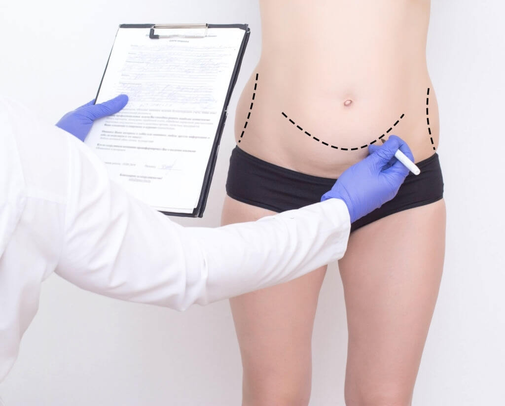 Patient undergoing abdominoplasty at Kakar Healthcare Clinic in Janakpuri, Delhi - Safe and professional cosmetic surgery.