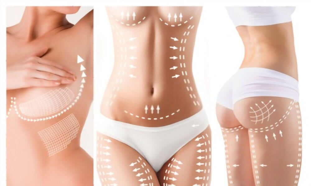 Patient undergoing body lift procedure at Kakar Healthcare Clinic in Janakpuri, Delhi - Expert body contouring for a sculpted appearance.
