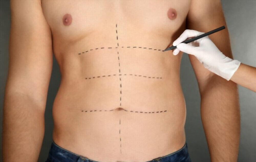 Postoperative care after body lift surgery at Kakar Healthcare Clinic in Janakpuri, Delhi - Comprehensive support for optimal recovery and results.